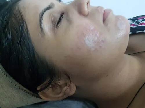 Dans les soins de la peau, quel anglicisme désigne une exfoliation chimique ?